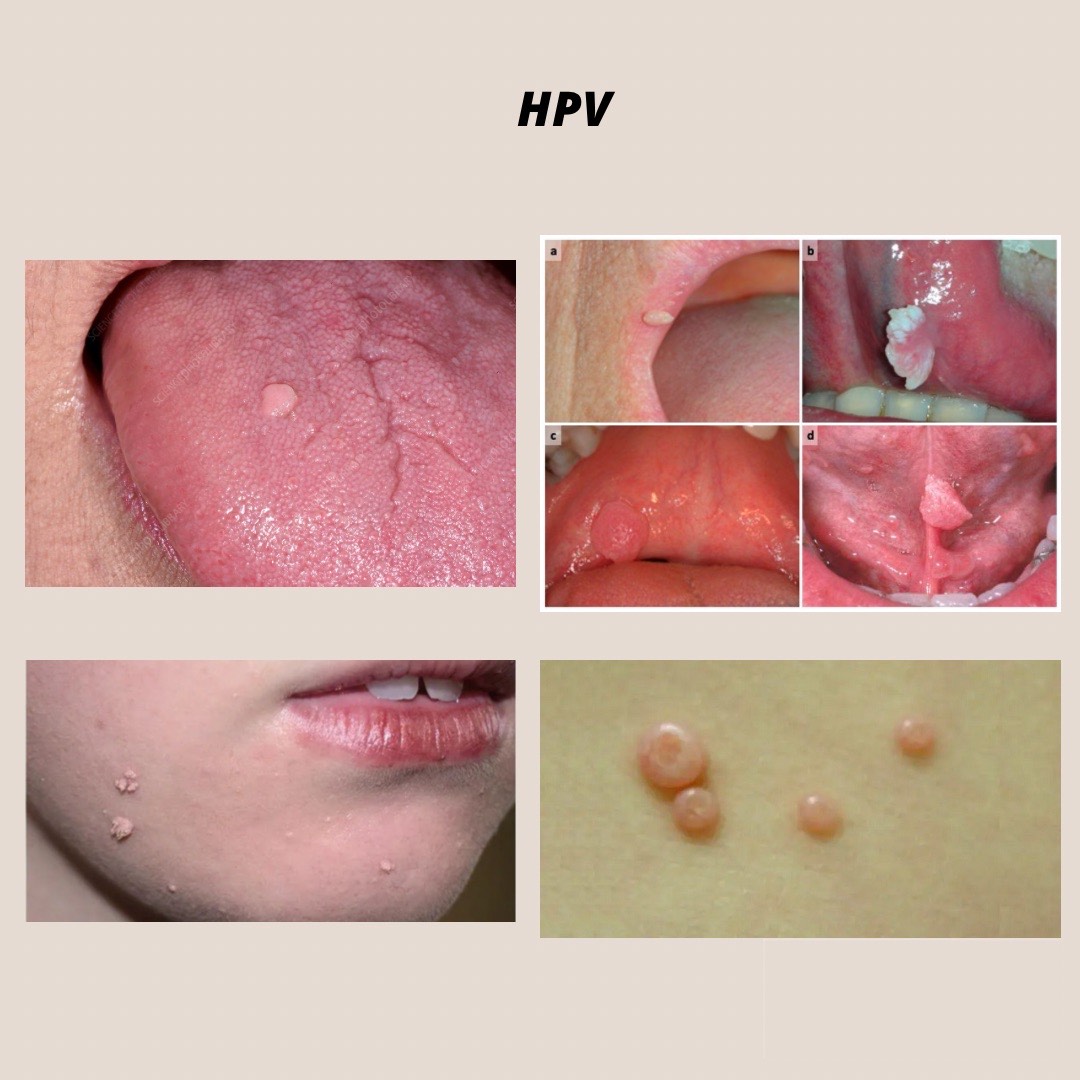 Virusi papilloma, papilloma ne meshkujt, vaksina hpv, HPV shenjat