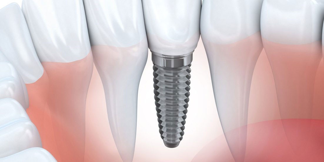 Implantet dentare